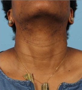 Laser Hair Reduction - Case 14499 - After