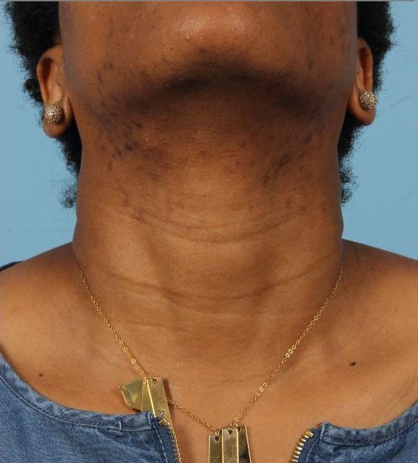 Laser Hair Reduction Patient Photo - Case 14499 - after view