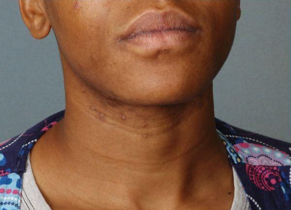 Laser Hair Reduction Patient Photo - Case 14499 - before view-1