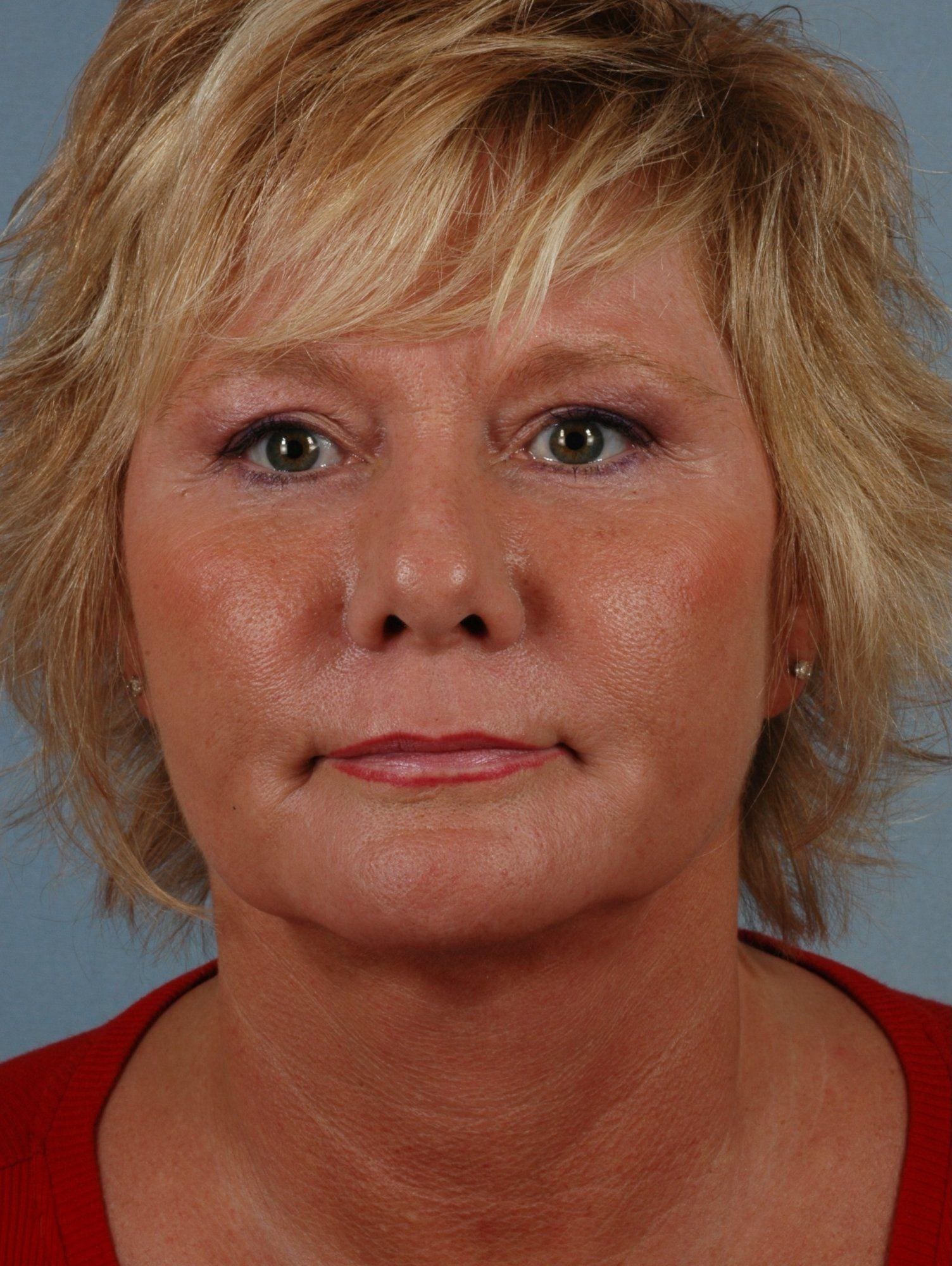 Dermal Fillers Patient Photo - Case 14507 - before view-