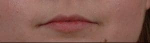Dermal Fillers - Case 14511 - Before
