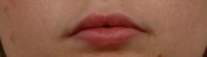 Dermal Fillers - Case 14511 - After