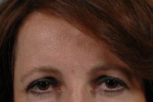Dermal Fillers - Case 14515 - After