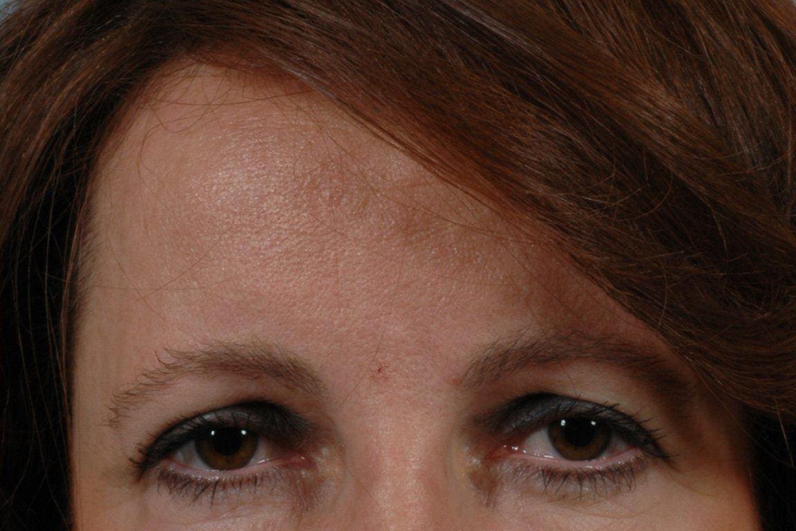 Dermal Fillers Patient Photo - Case 14515 - after view