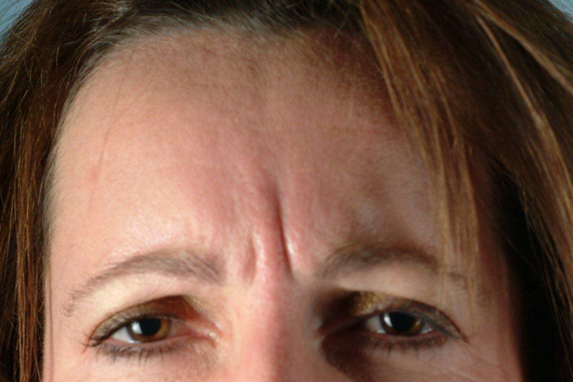 Dermal Fillers Patient Photo - Case 14515 - before view-