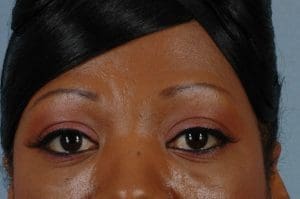 Dermal Fillers - Case 14519 - After