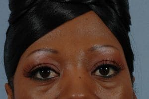 Dermal Fillers - Case 14519 - Before