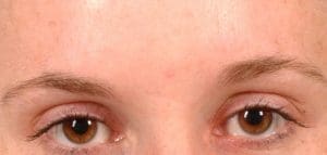 Dermal Fillers - Case 14523 - After