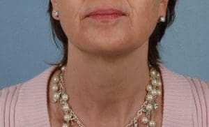 Dermal Fillers - Case 14532 - Before