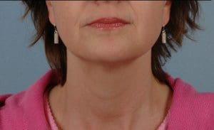 Dermal Fillers - Case 14532 - After