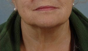 Dermal Fillers - Case 14536 - After