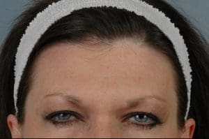 Dermal Fillers - Case 14541 - After