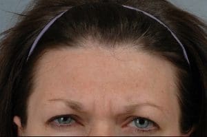 Dermal Fillers - Case 14541 - Before