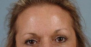 Dermal Fillers - Case 14546 - After