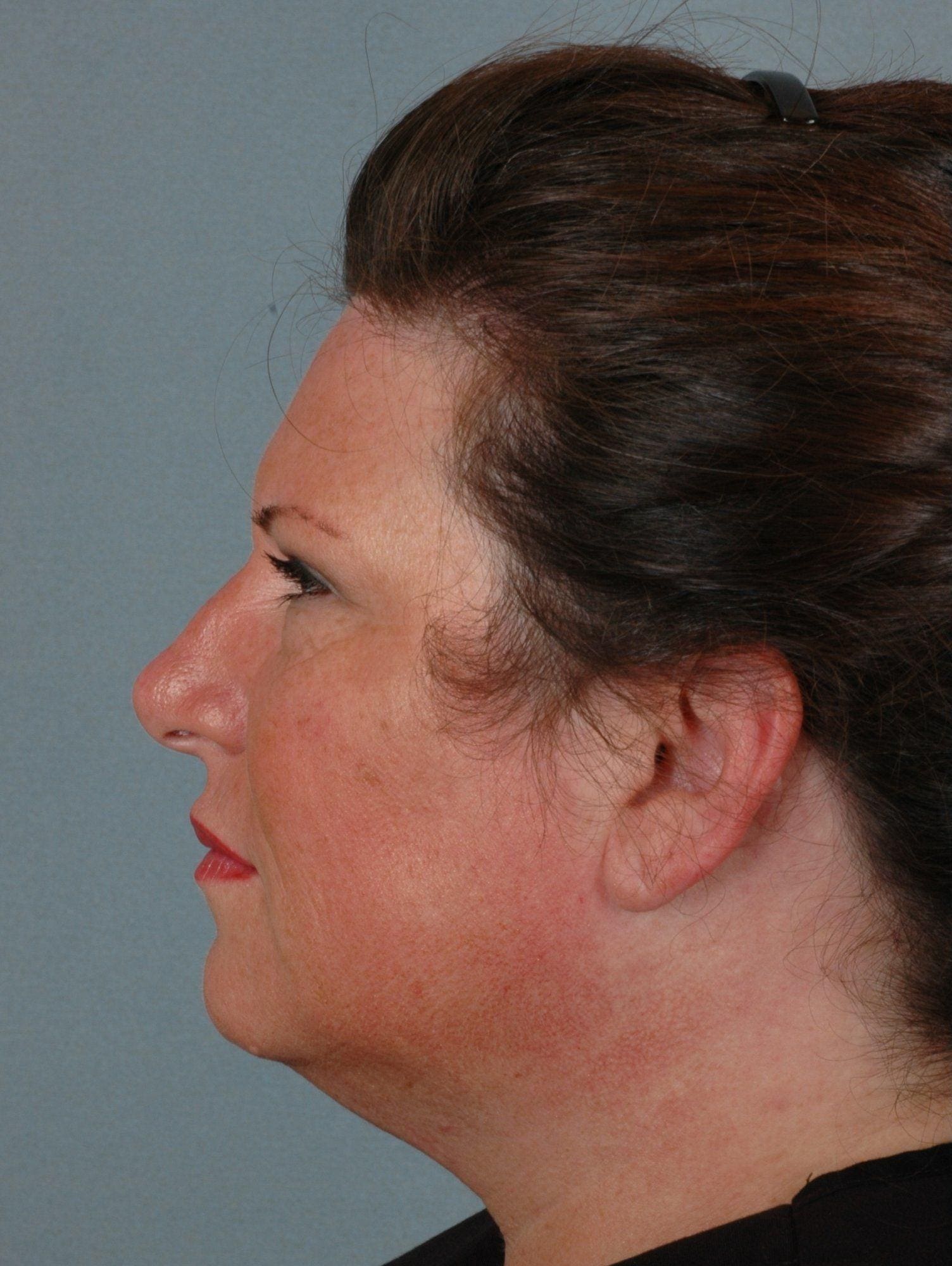 Dermal Fillers Patient Photo - Case 14551 - before view-1