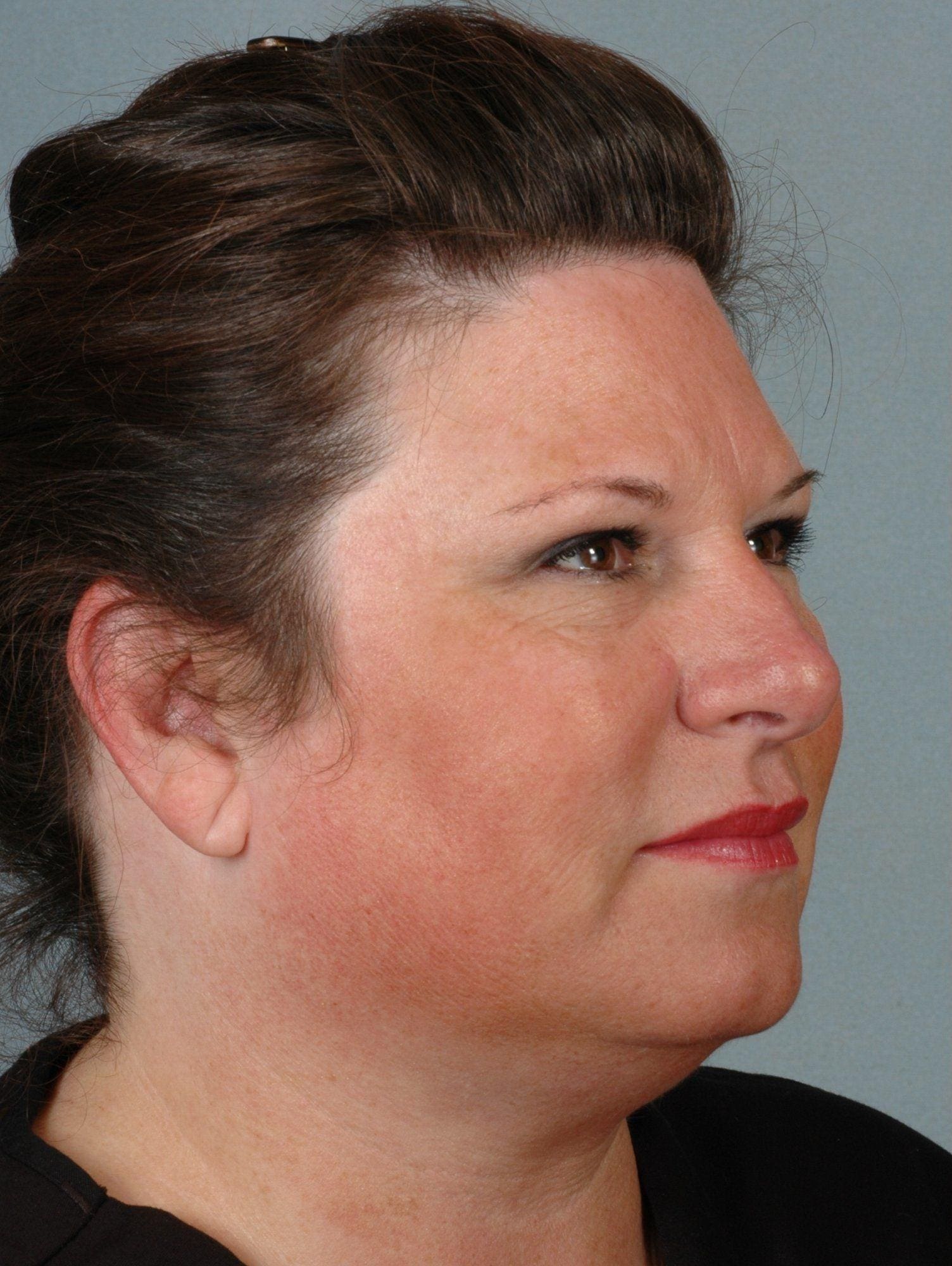 Dermal Fillers Patient Photo - Case 14551 - before view-4