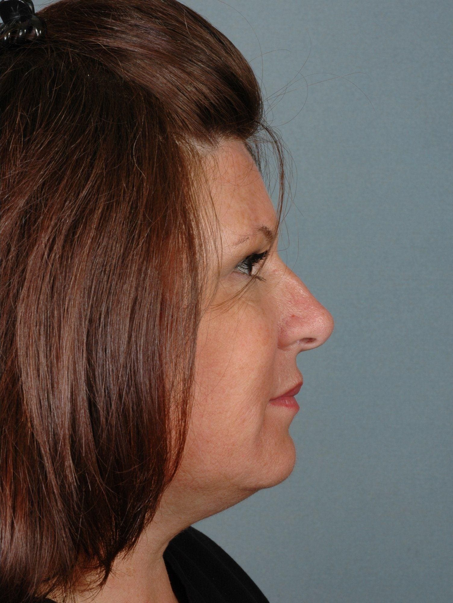 Dermal Fillers Patient Photo - Case 14551 - after view-2