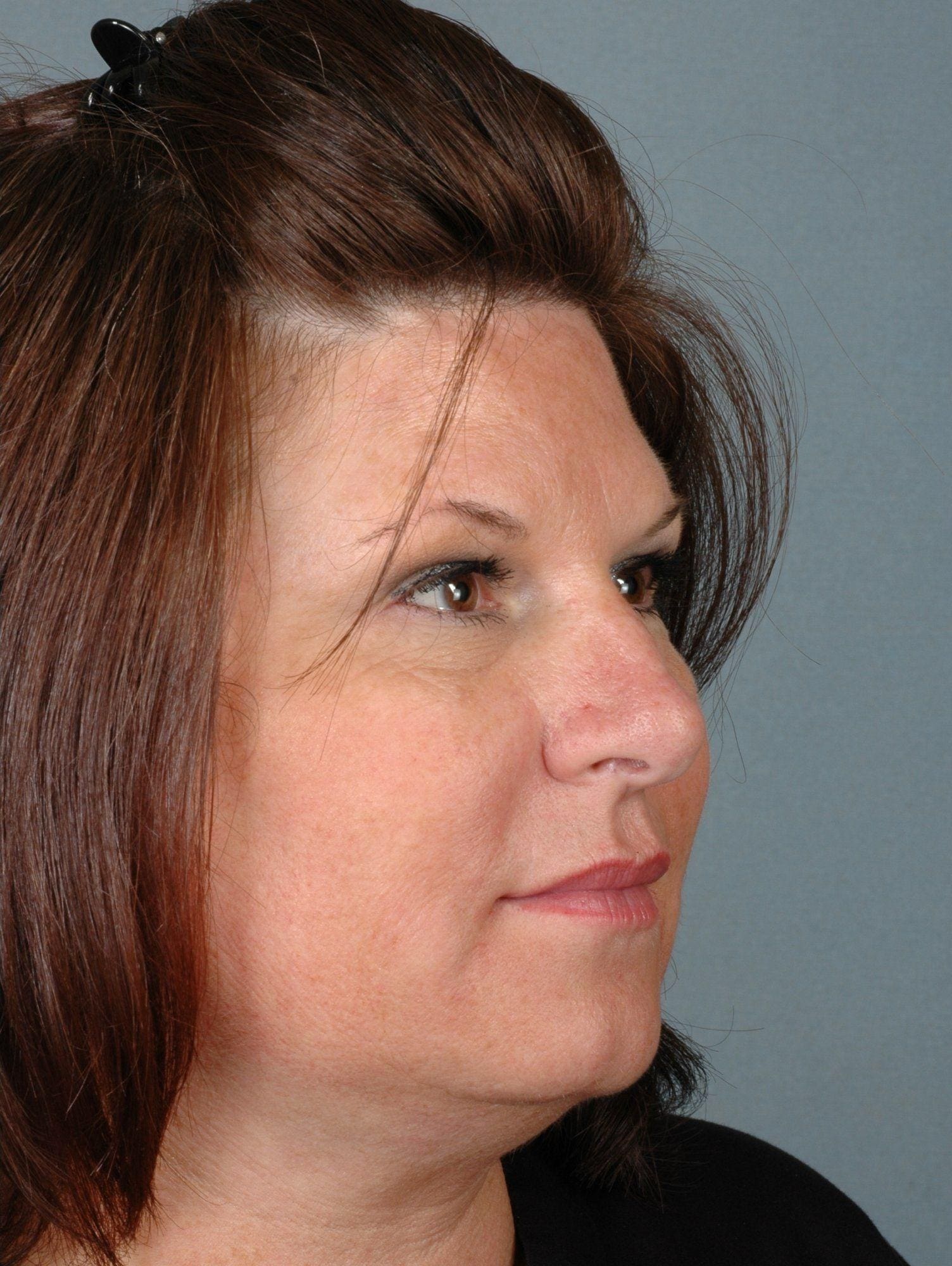 Dermal Fillers Patient Photo - Case 14551 - after view-4