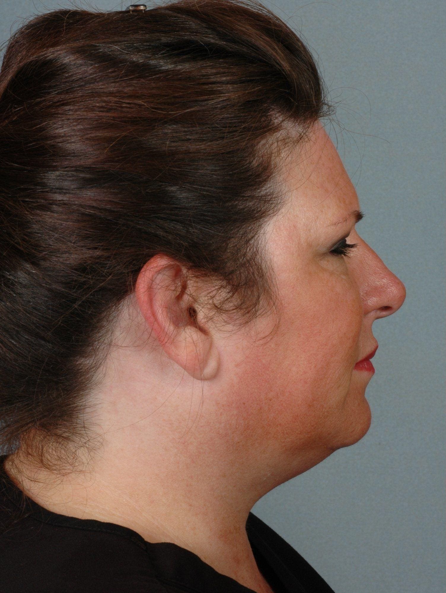 Dermal Fillers Patient Photo - Case 14551 - before view-2