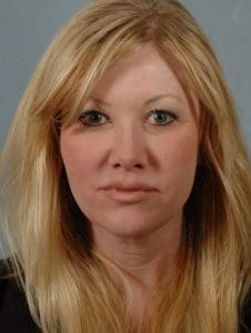 Dermal Fillers - Case 14564 - After