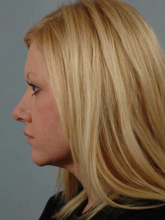 Dermal Fillers Patient Photo - Case 14564 - before view-1