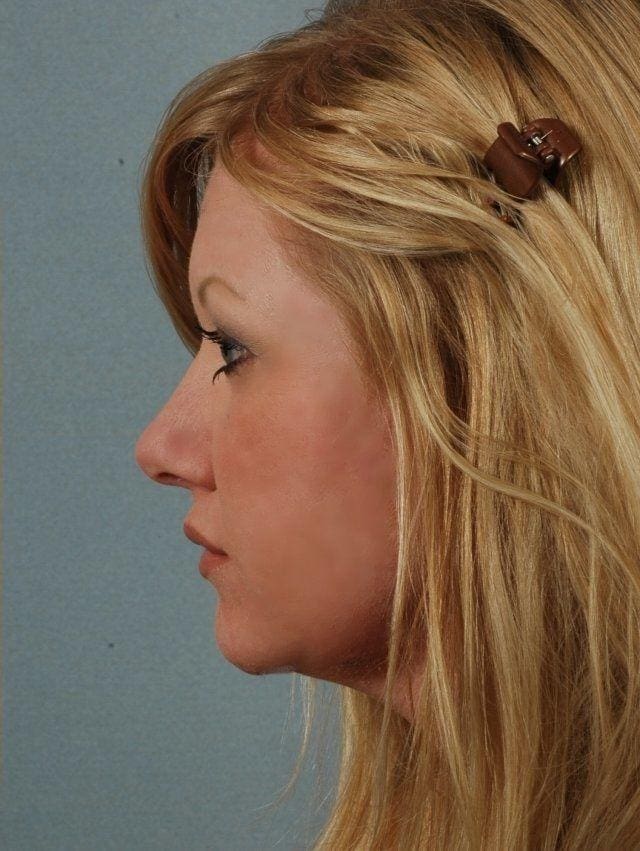 Dermal Fillers Patient Photo - Case 14564 - after view-1