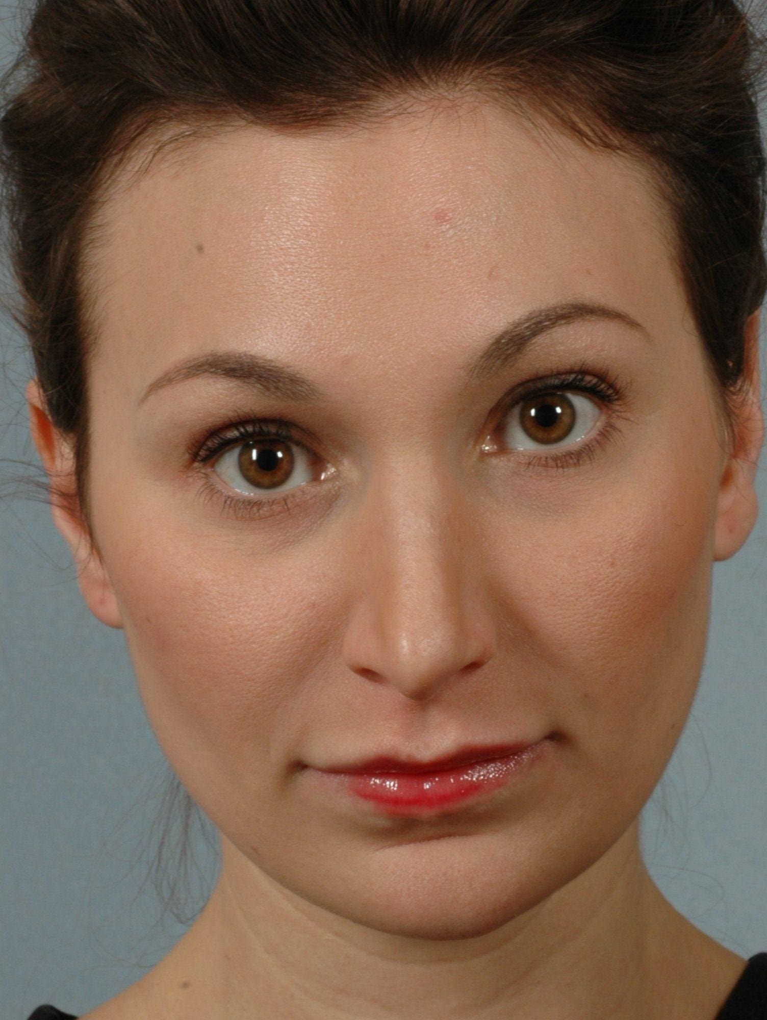 Injectable Fillers Patient Photo - Case 14570 - after view-1