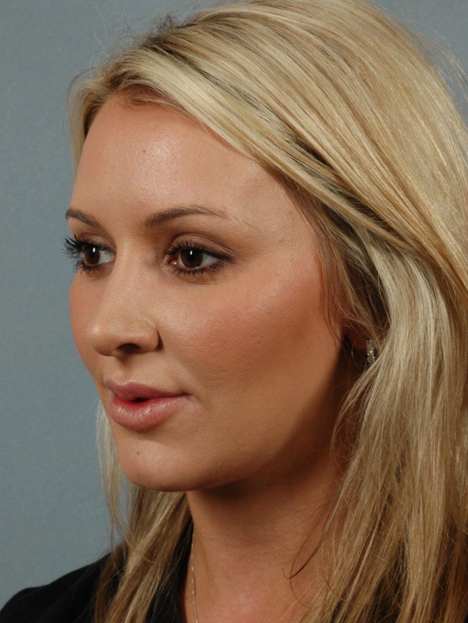 Dermal Fillers Patient Photo - Case 14578 - after view-1