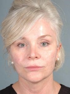 Dermal Fillers - Case 14584 - Before