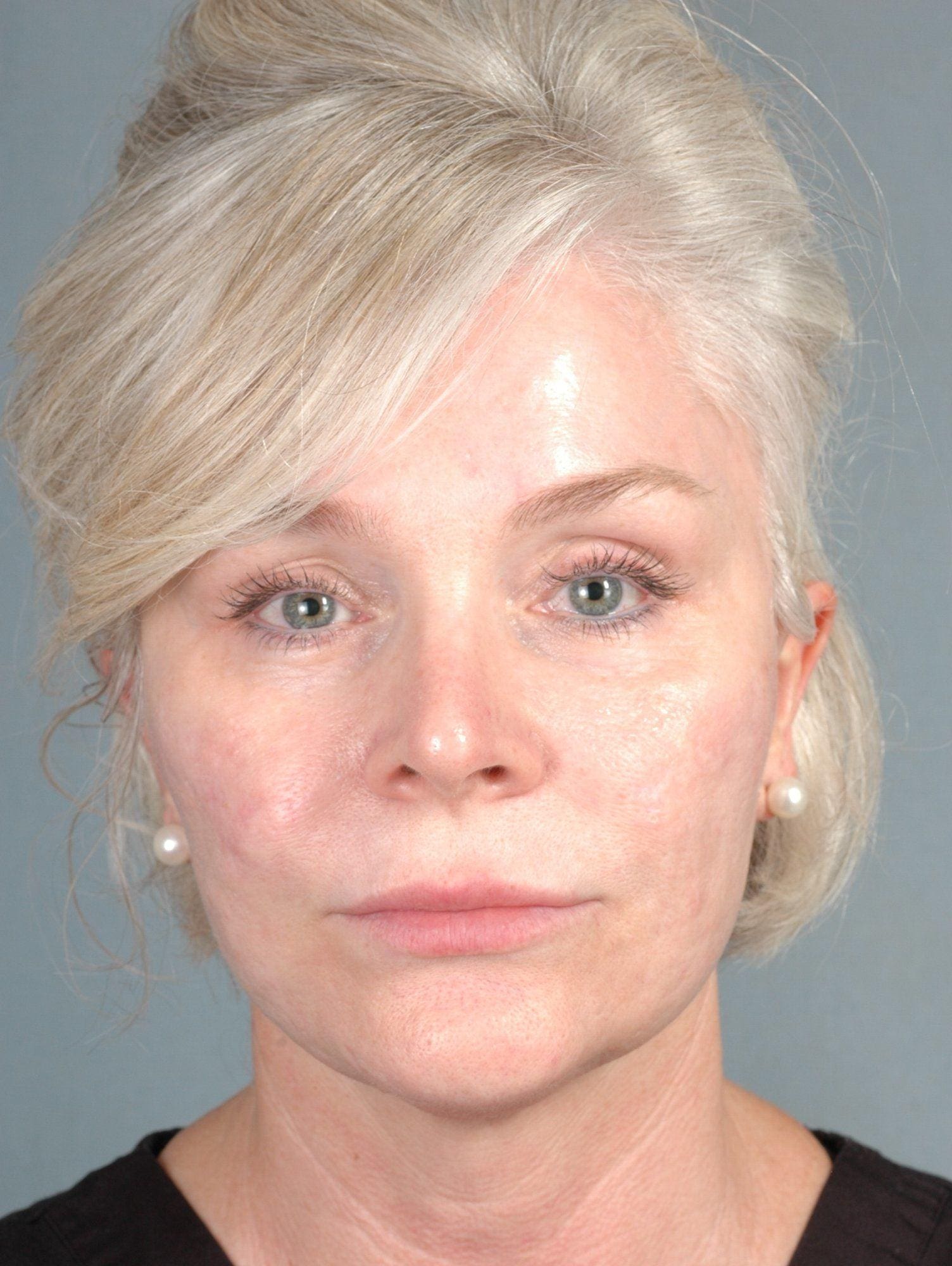 Injectable Fillers Patient Photo - Case 14584 - before view-