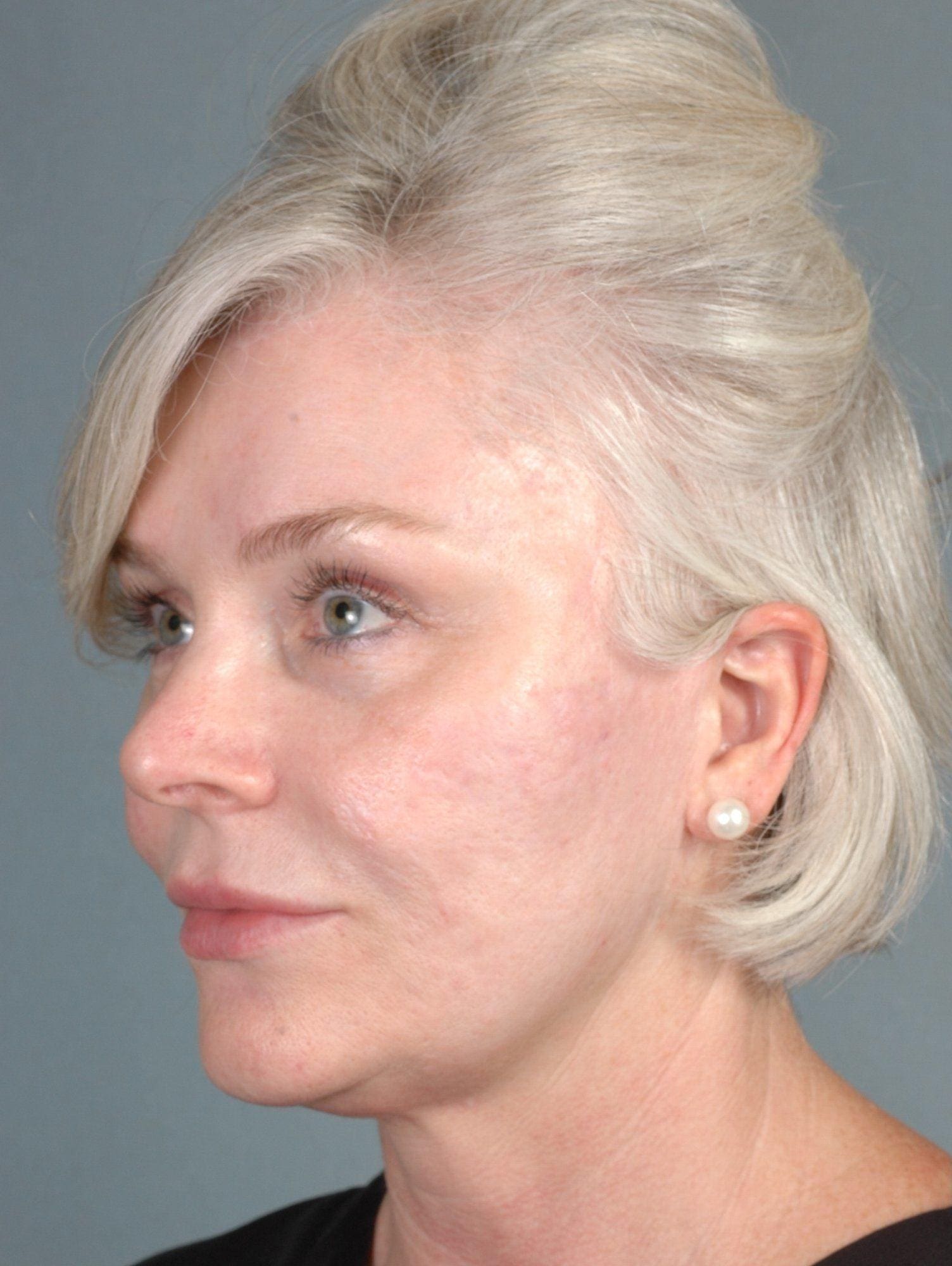 Injectable Fillers Patient Photo - Case 14584 - before view-1