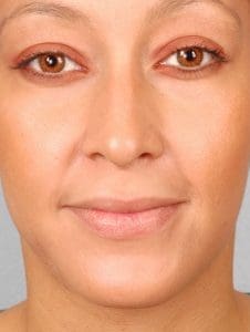 Dermal Fillers - Case 14595 - Before