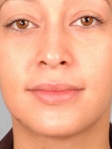 Dermal Fillers - Case 14595 - After