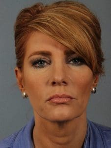 Dermal Fillers - Case 14600 - After
