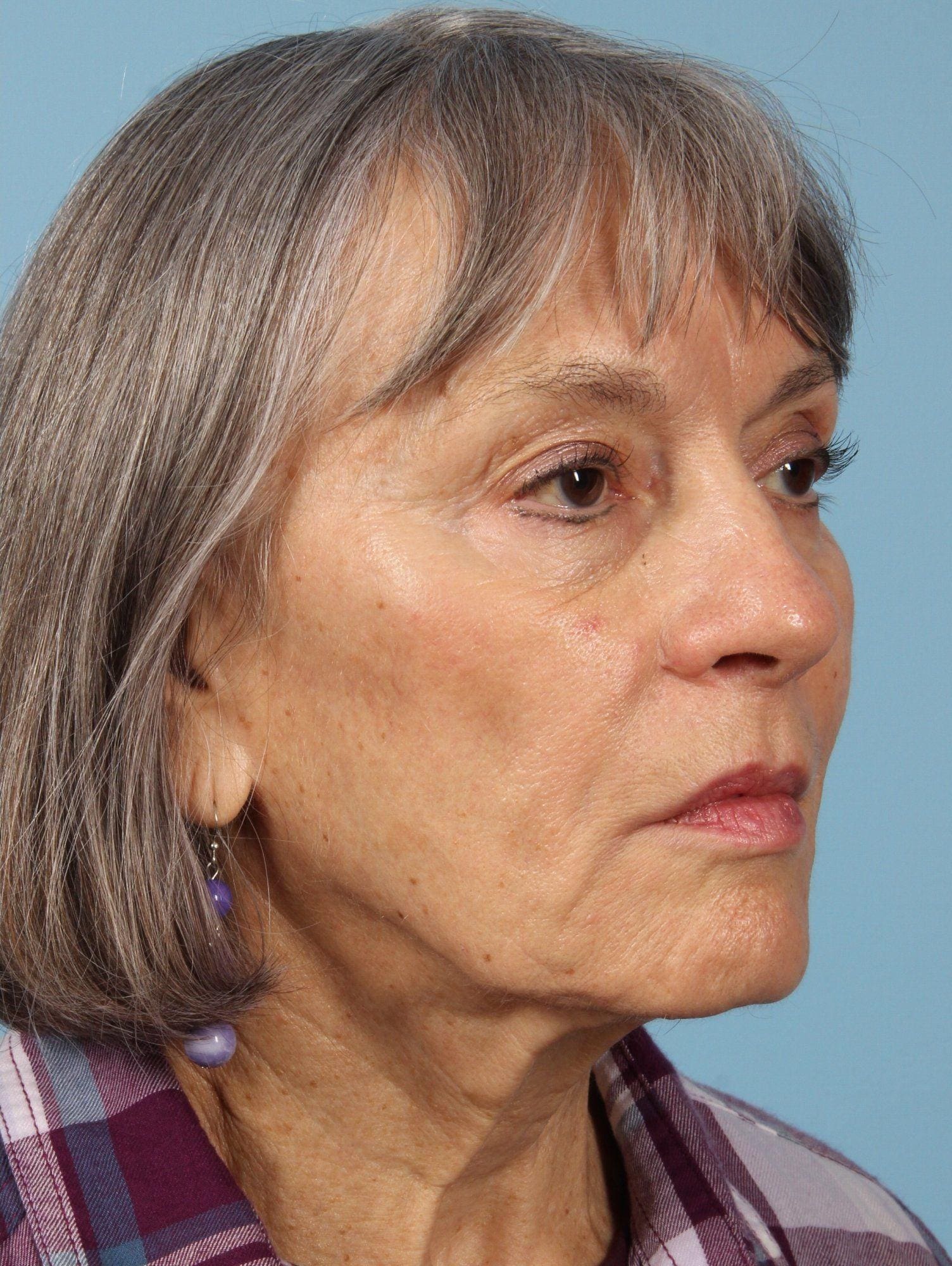 Injectable Fillers Patient Photo - Case 14604 - after view-2