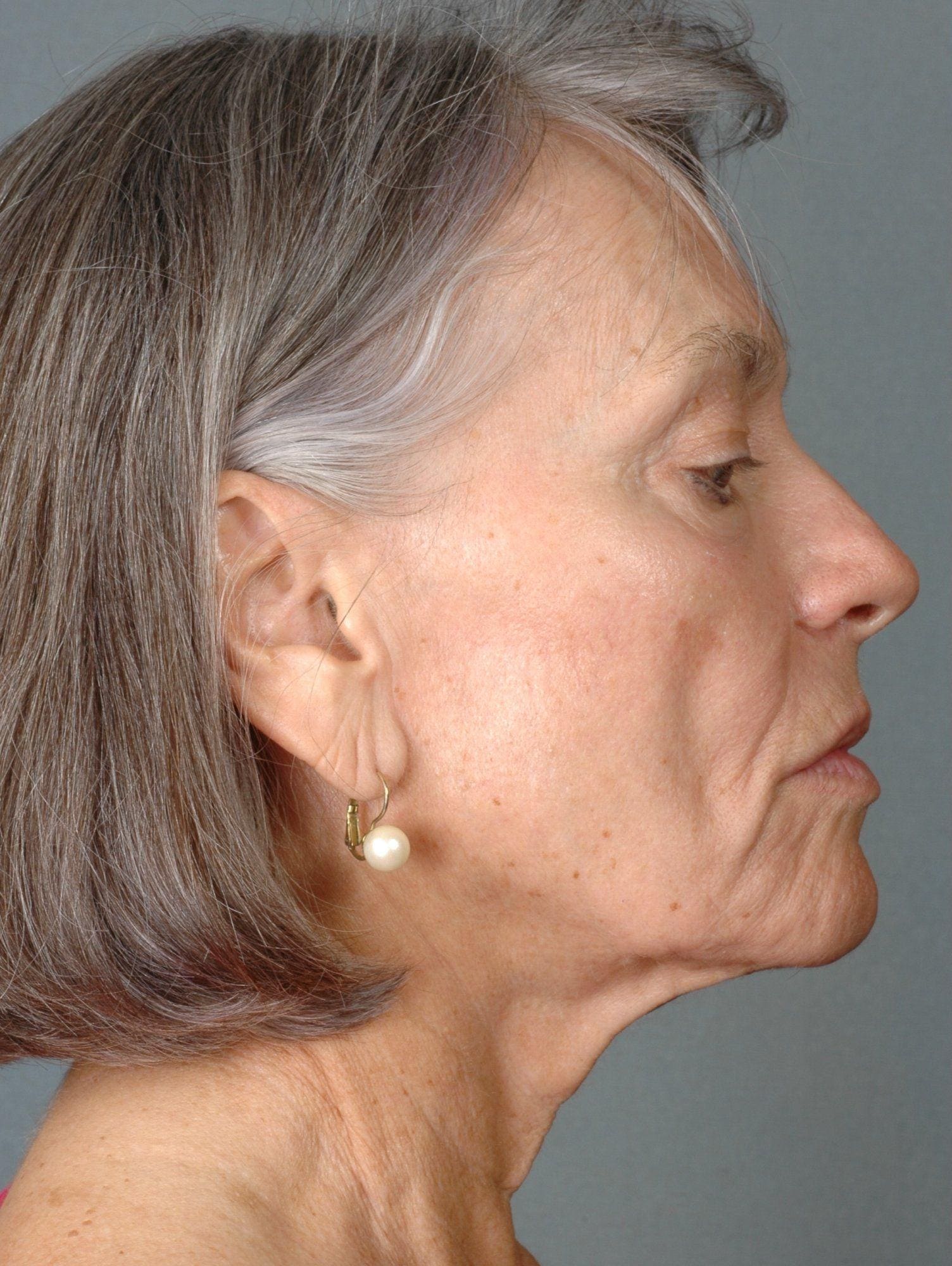 Injectable Fillers Patient Photo - Case 14604 - before view-1