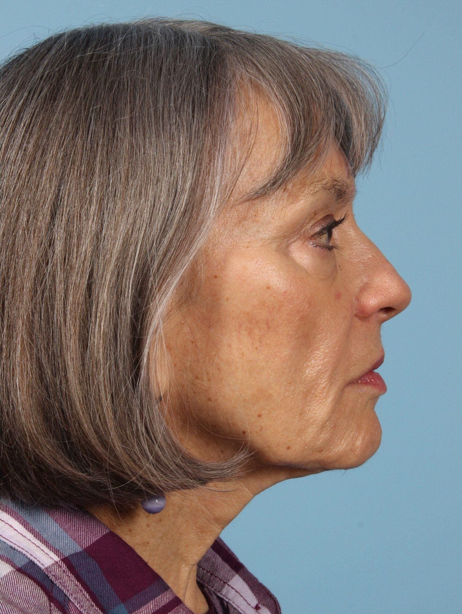 Injectable Fillers Patient Photo - Case 14604 - after view-1