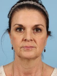 Dermal Fillers - Case 14616 - Before