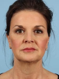 Dermal Fillers - Case 14616 - After