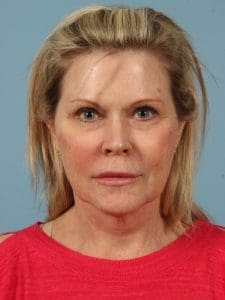 Dermal Fillers - Case 14624 - After