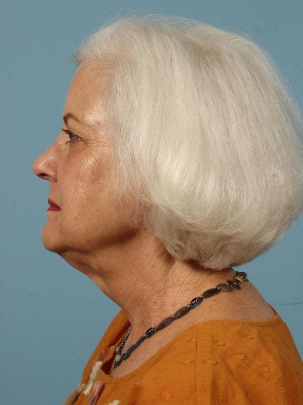 Dermal Fillers Patient Photo - Case 14633 - after view-1