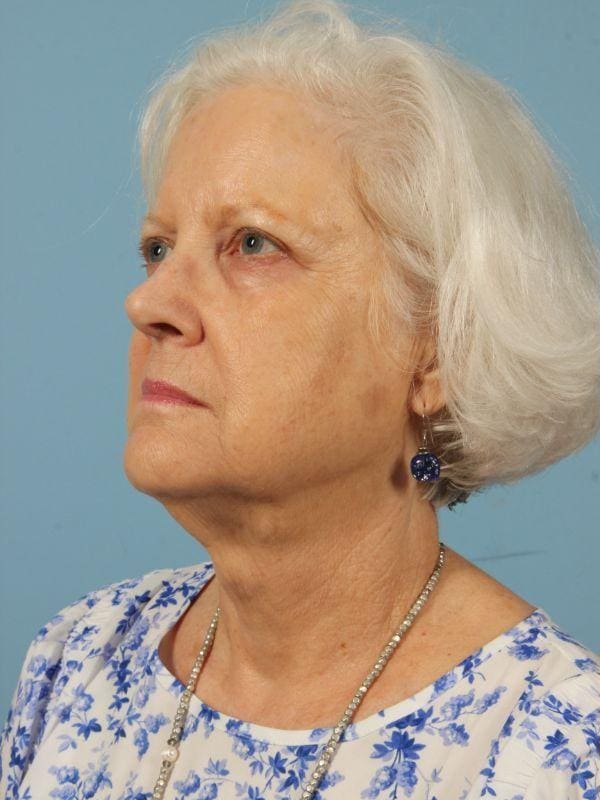 Dermal Fillers Patient Photo - Case 14633 - before view-2