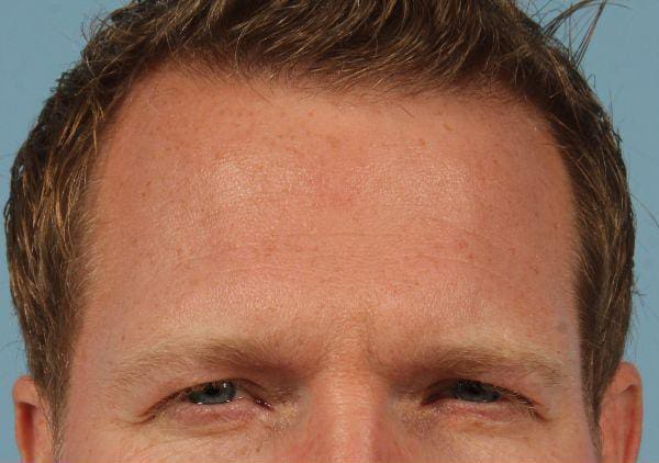Dermal Fillers Patient Photo - Case 14646 - before view-1