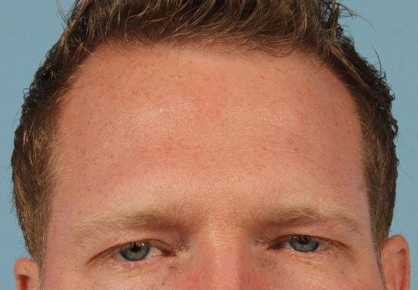Dermal Fillers Patient Photo - Case 14646 - after view-1