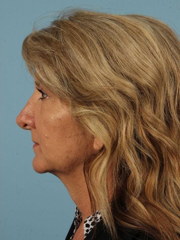 Injectable Fillers Patient Photo - Case 14653 - after view-1