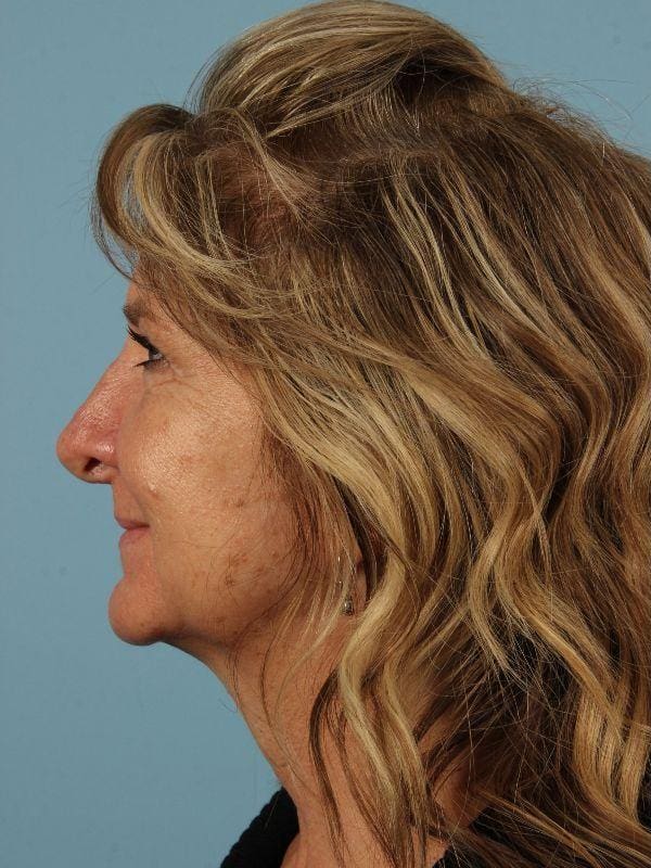 Injectable Fillers Patient Photo - Case 14653 - before view-1