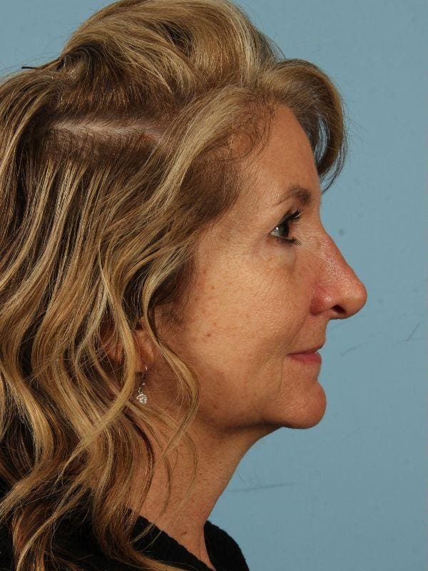 Injectable Fillers Patient Photo - Case 14653 - before view-2