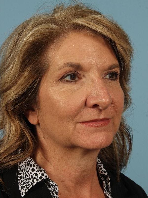 Injectable Fillers Patient Photo - Case 14653 - after view-4