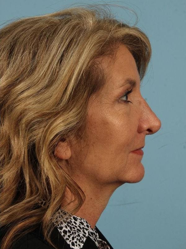 Injectable Fillers Patient Photo - Case 14653 - after view-2