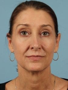Dermal Fillers - Case 14665 - Before
